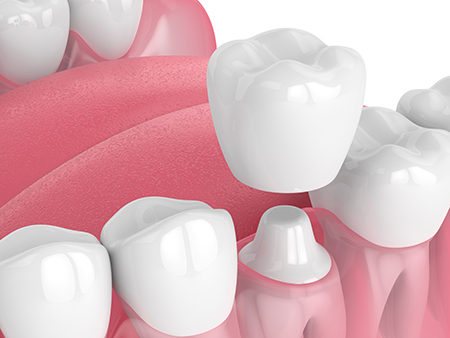The image displays a close-up of multiple tooth models, showcasing their shapes and colors, with a focus on the front teeth, set against a red background that resembles a dental impression tray.