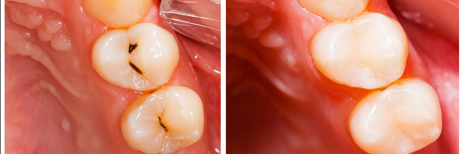 The image shows a close-up view of a dental implant with an exposed screw, possibly indicating a failed implant procedure.
