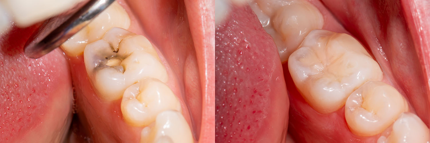 The image shows a close-up view of an open mouth with multiple teeth and gums, revealing dental decay and stained surfaces.